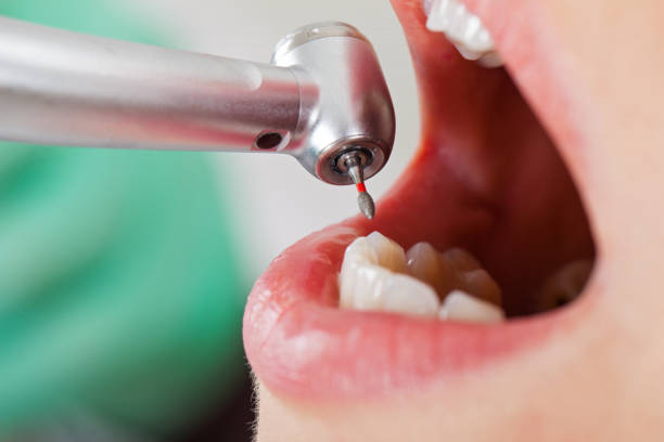 Best Emergency Dentist for Lost Fillings or Crowns in Homestead Valley, CA